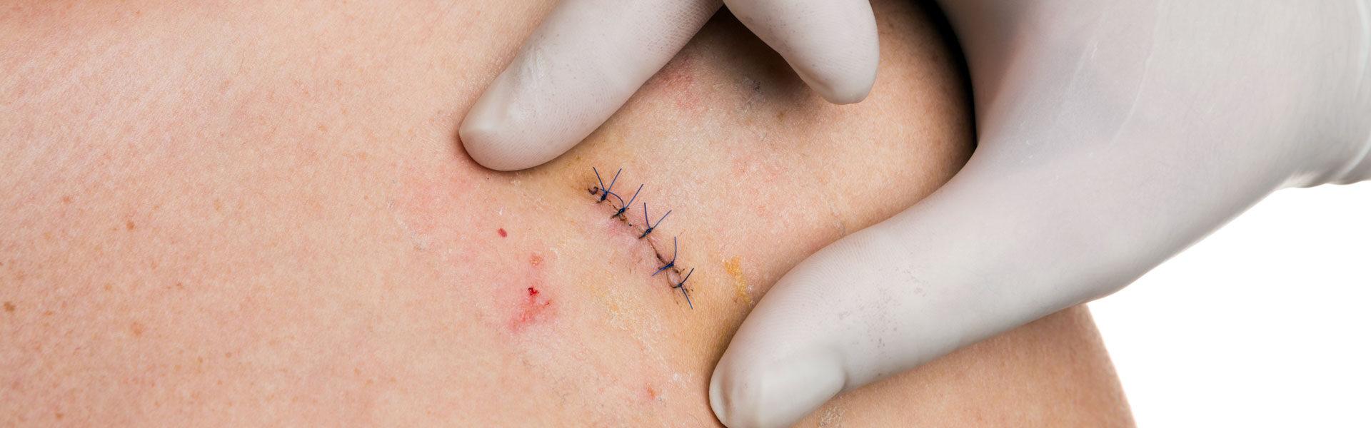 Laceration/Suture Repair in Richmond, TX 